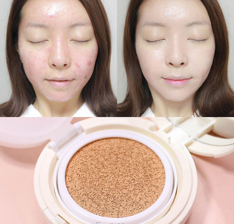 Top 5+ Cushion Cho Da Mụn Nhiều Khuyết Điểm Tốt Nhất 2025